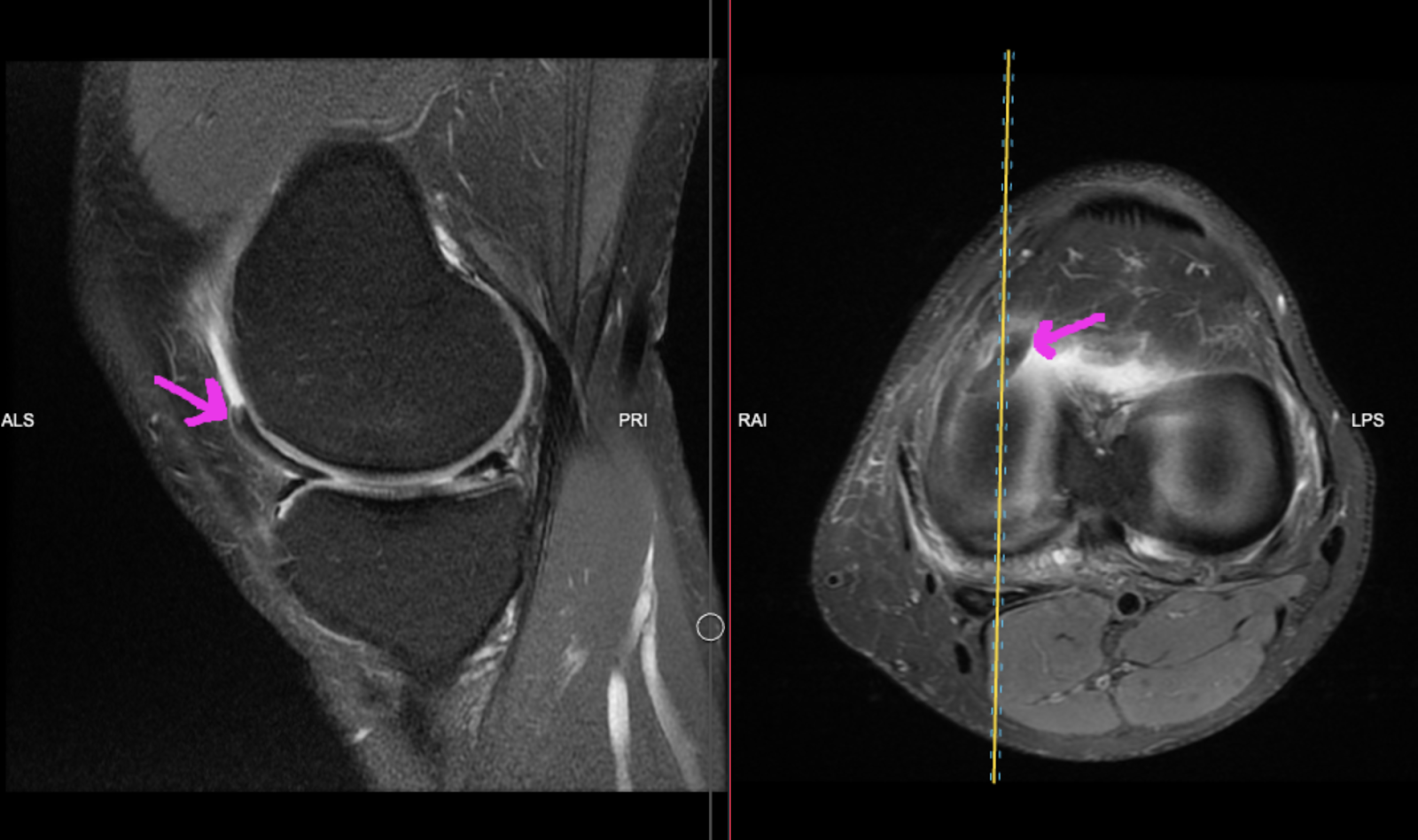 The Msk Playbook Meniscal Knee Injuries Bjsm Blog Social Media S