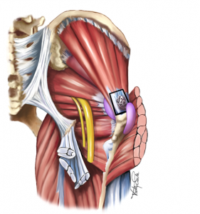 'Trochanteric bursitis'? Consider gluteal tendinopathy as a more likely