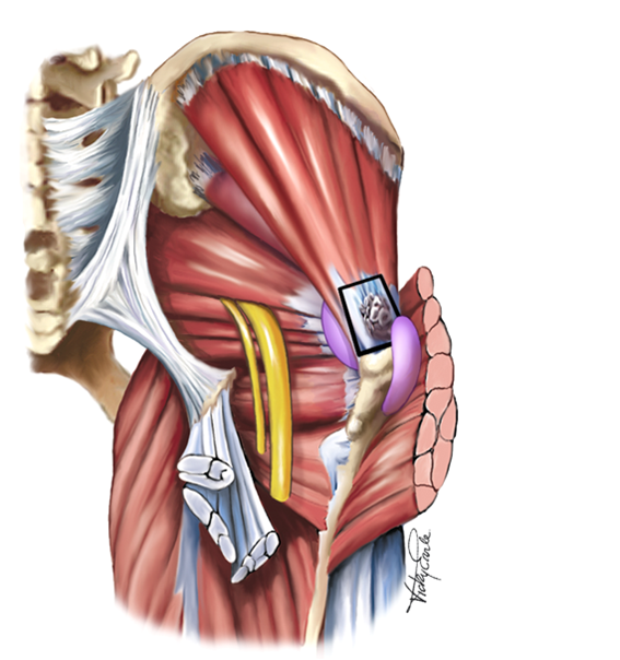 Lateral Hip Pain/ Trochanteric Bursitis