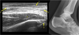 ankle xray