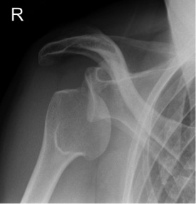 shoulder x0ray