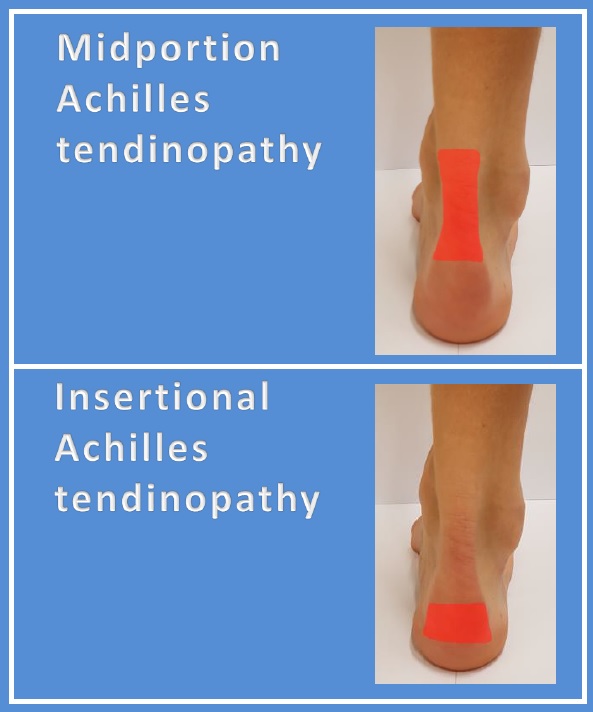 for Achilles tendinopathy 
