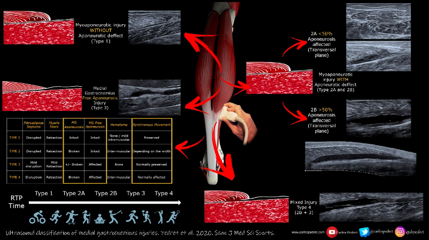 Calf tears and their diagnosis.