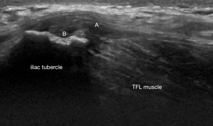 High-resolution ultrasound of the fascia lata iliac crest