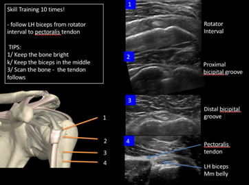 PDF] Ultrasonography as a diagnostic tool in assessing deltoid