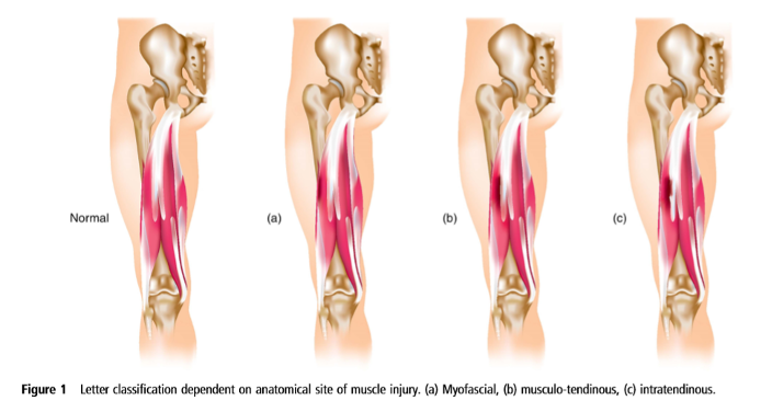 Hamstring injury