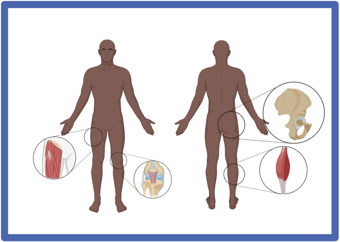 Trochanteric bursitis'? Consider gluteal tendinopathy as a more likely  diagnosis. - BJSM blog - social media's leading SEM voice