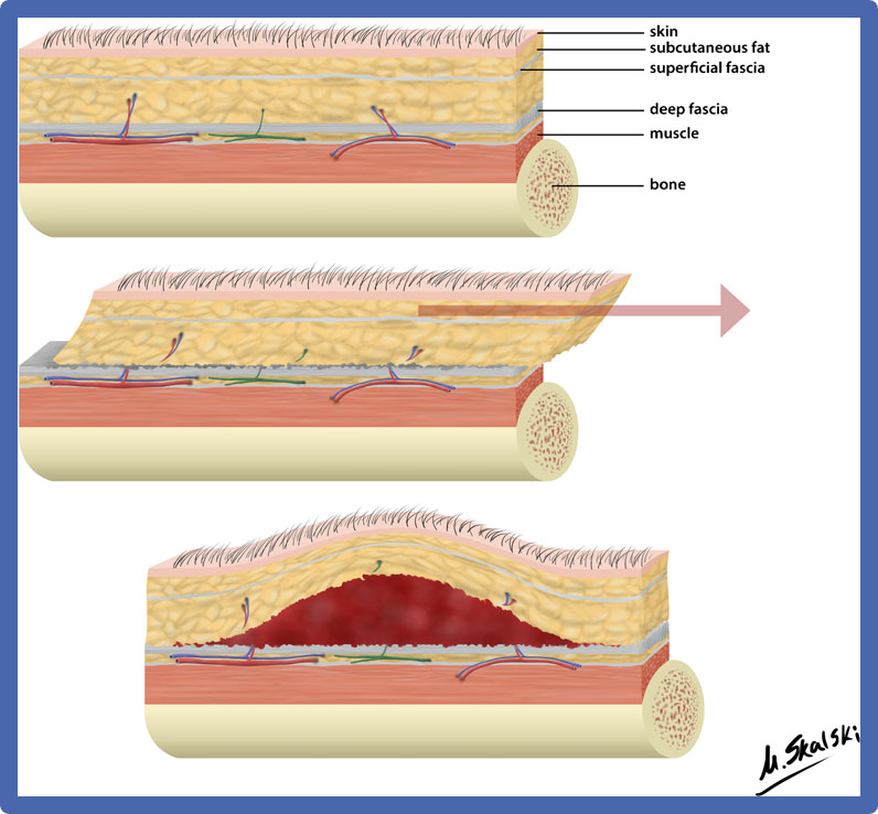 Morel Lavallee Lesions Diagnosis and practical management of