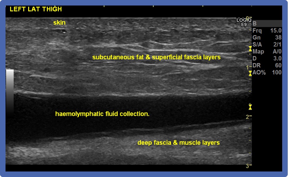 Morel-Lavallee Lesions - Diagnosis and practical management of these troublesome injuries! - BJSM blog - social media's leading SEM voice