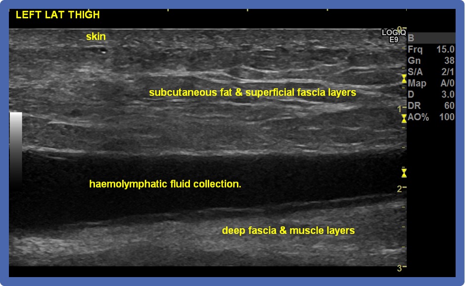 Morel Lavallee Lesions Diagnosis and practical management of