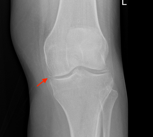 The MSK Playbook: Chondrocalcinosis Pathway - BJSM blog - social media ...