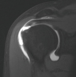 Arthroscopic Rotator Cuff Repair Utilizing Cascade System - Part I