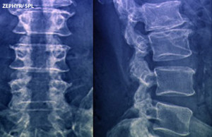 laminectomy_for_spinal_stenosis,
