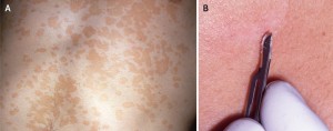 pityriasis