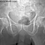 hip_fracture_xray