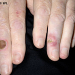 pyoderma-gangrenosum