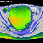 ovarian_cancer_mri