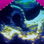 empty_gestational_sac