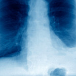 Pleural effusion. Coloured frontal X-ray of the lungs of a 60-year-old patient with a pleural effusion of the left lung (right). The lungs are the dark spaces either side of the chest. The left lung is smaller than the right lung due to a pleural effusion, an accumulation of fluid (lower right) in the chest cavity. The liquid compresses the lung, which leads to breathing difficulties. An effusion is treated by aspiring (draining) the fluid, which relieves the pressure.