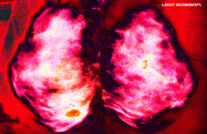 Mammogram. Coloured mammogram (breast X-ray) showing a malignant (cancerous) tumour (patchy area) in the patient's breast. Breast cancer is the most common type of cancer in women. The cancer can invade surrounding tissue and spread to other parts of the body (metastasis). Treatment is with removal of the tumour, or complete removal of the breast. Surgery is often combined with radiation therapy and chemotherapy.