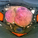 uterine_fibroids