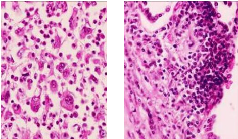 A non-small cell lung cancer (left) and a small-cell lung cancer (right)