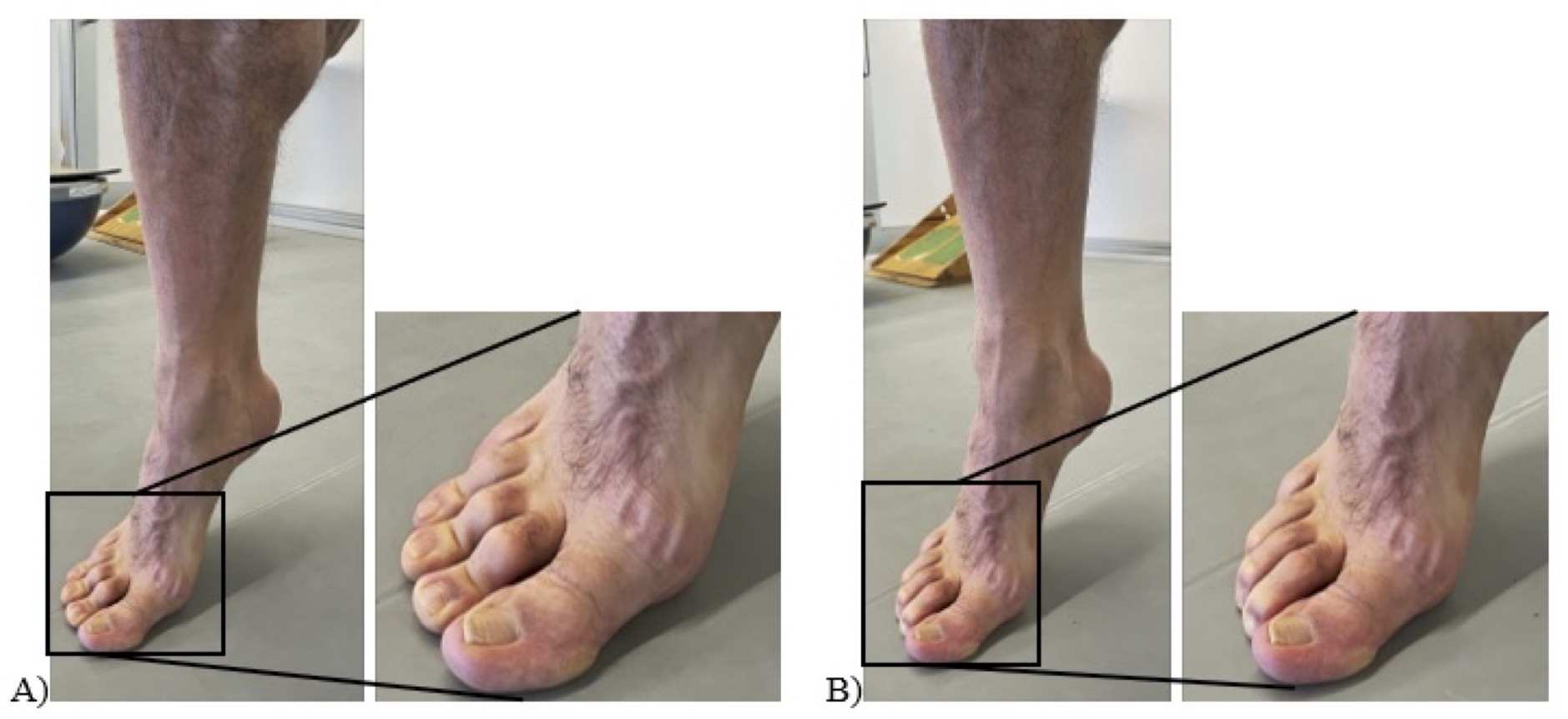 Clinical Tips Ana Azevedo On Single Leg Heel Raises Down Under The Foot The Bmj Open Sport 8894