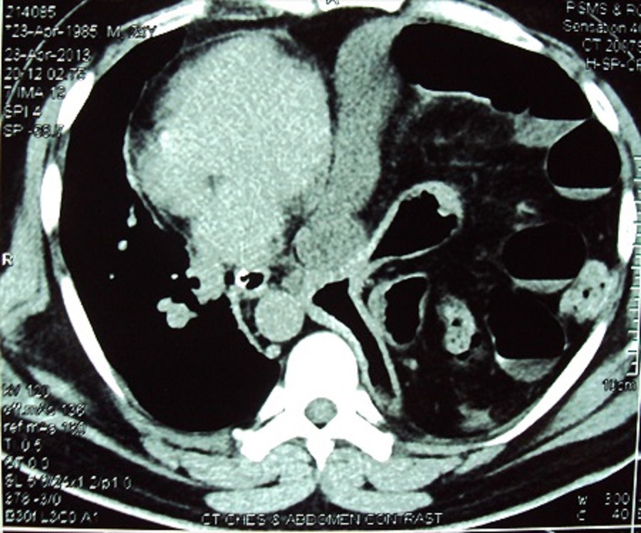 The Case Of Abnormal Abdominal Pain Bmj Case Reports Blog
