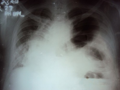 Chest_X_Ray