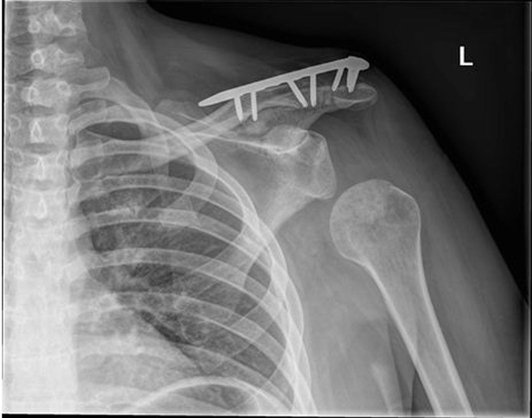 The case of the brachial plexus injury | BMJ Case Reports blog