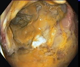 Figure_2-Colonoscopic_image__showing__ulcerations_with_yellowish_exudates_in_the_caecum