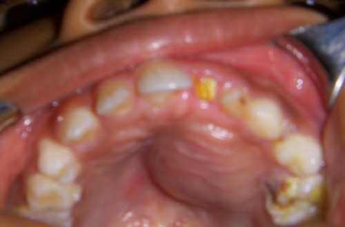 figure_1-Intraoral_Preoperative_view