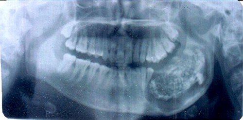 Complex Composite Odontoma