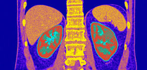 kidney-problems_533x255_C0213569