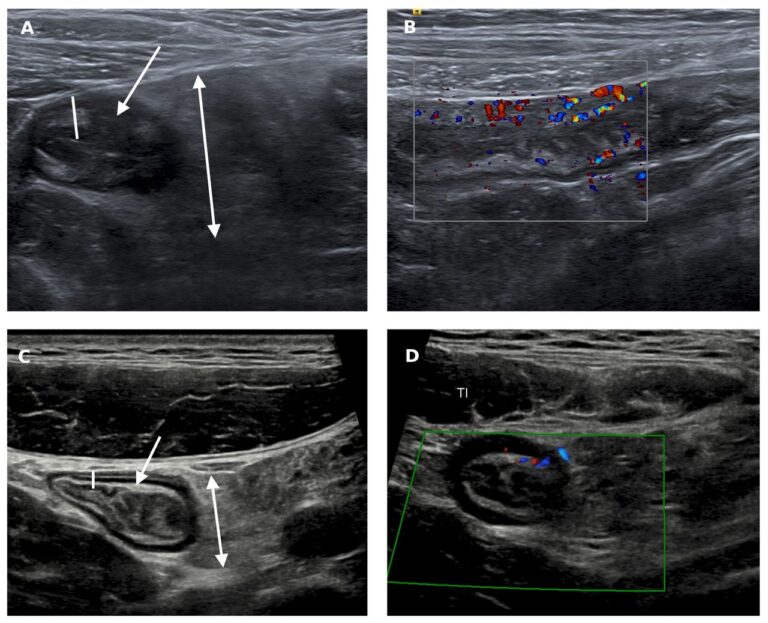 Intestinal ultrasound assessment in IBD: another string to the ...