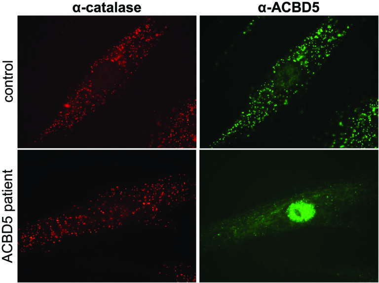 ACBD5 deficiency causes a defect in peroxisomal very long-chain fatty