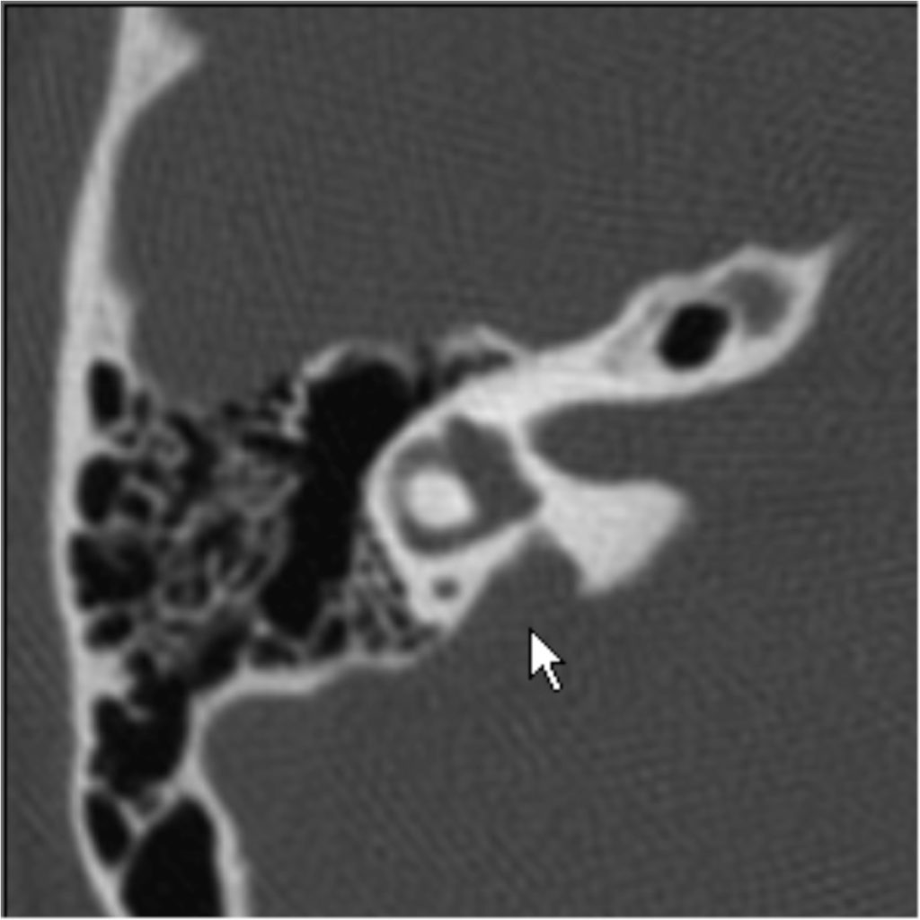 A common SLC26A4-linked haplotype underlying non-syndromic hearing loss ...