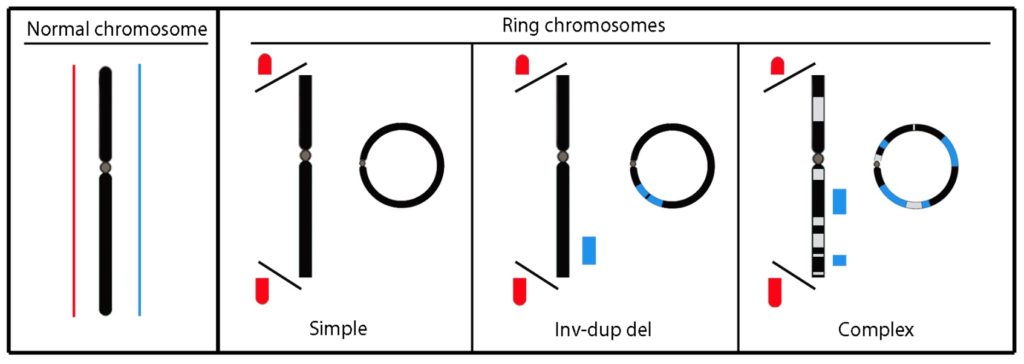 Chromothripsis and ring chromosome 22: a paradigm of genomic complexity