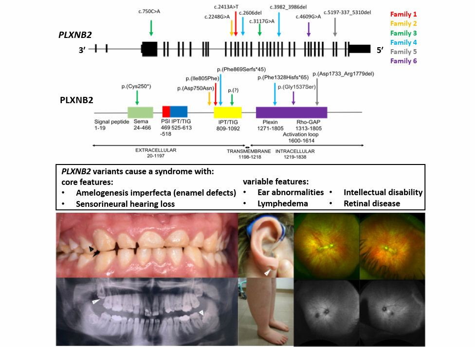 Biallelic Variants In Plexin B2 PLXNB2 Cause Amelogenesis Imperfecta 