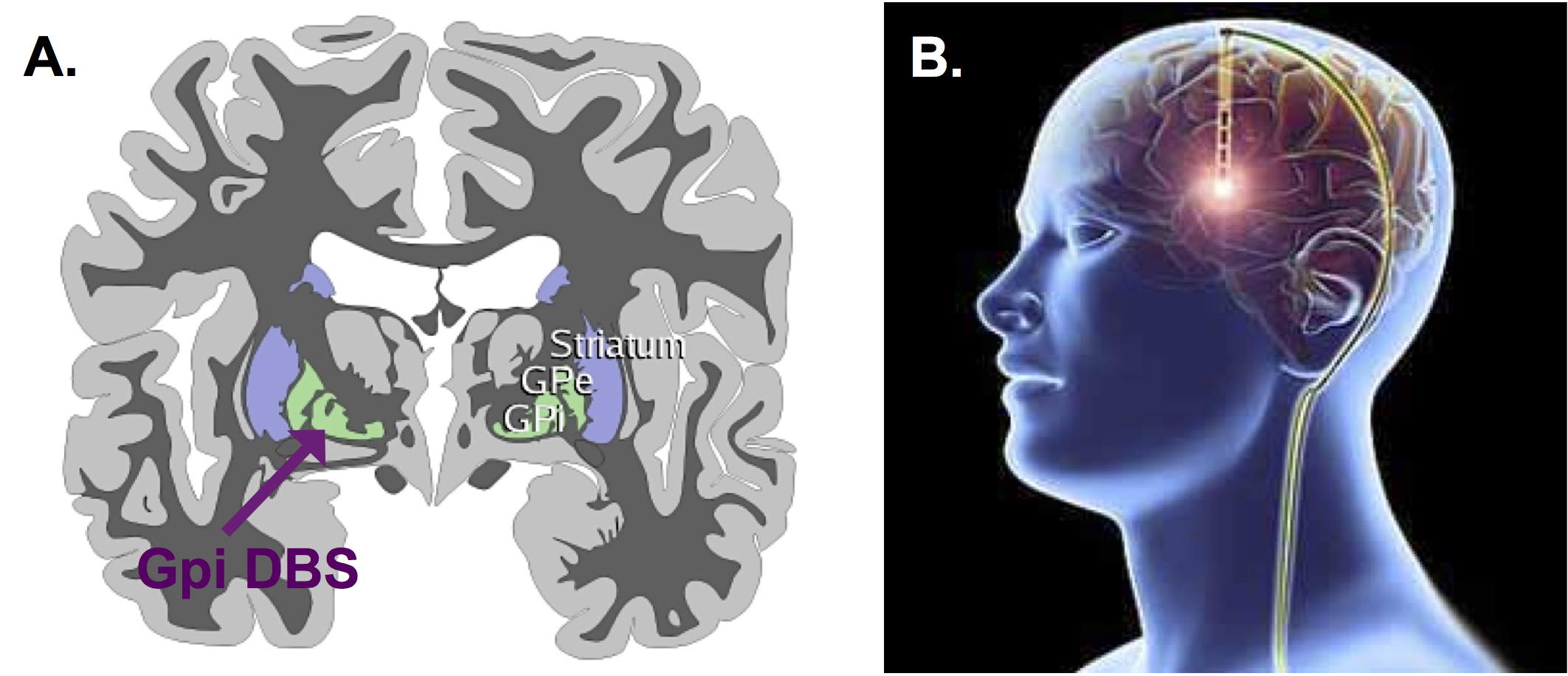 Deep brain stimulation in dystonia: it a long-term effective safe - JNNP blog