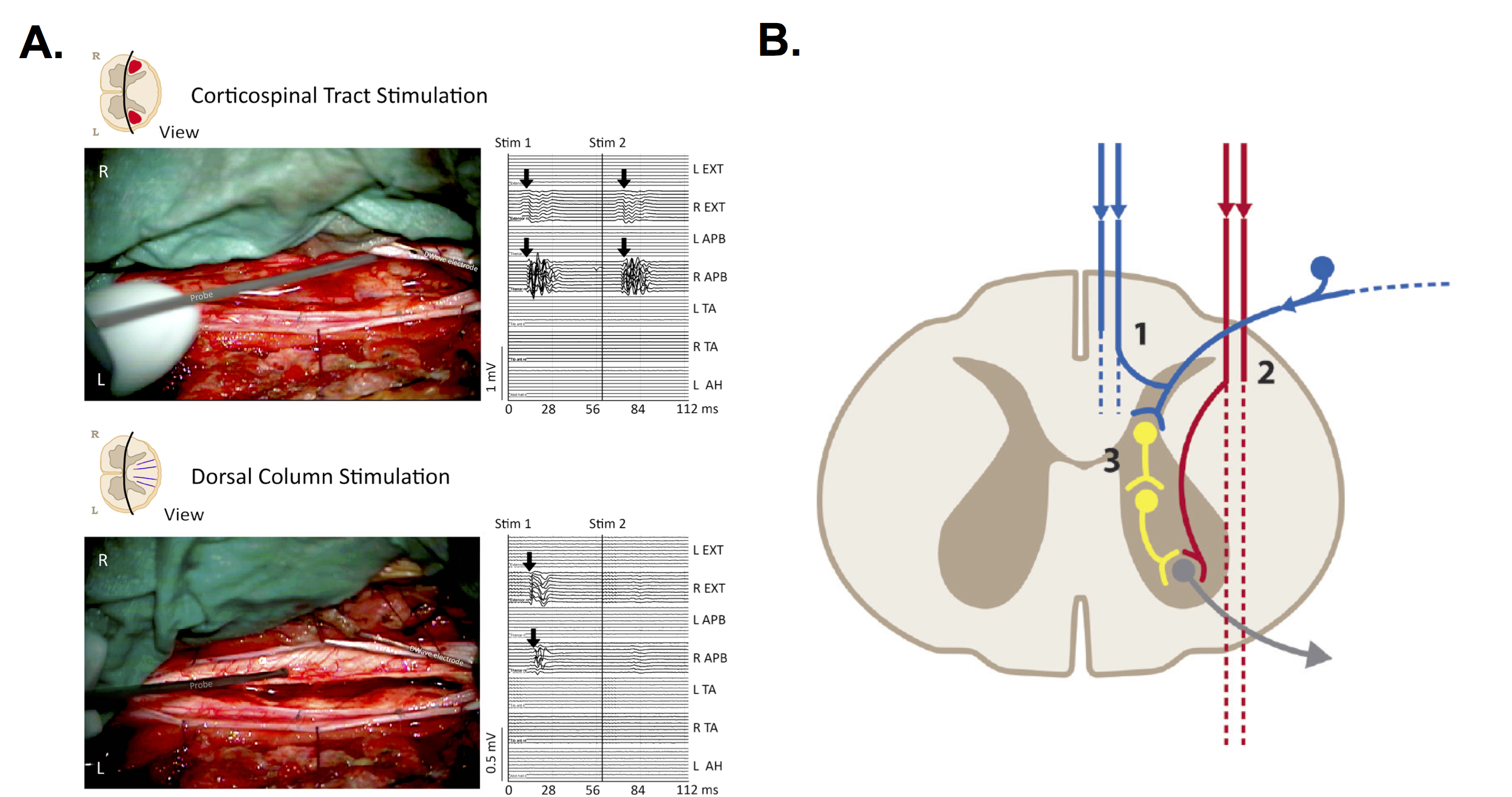 postsynaptic dorsal column spinal cord stimulation