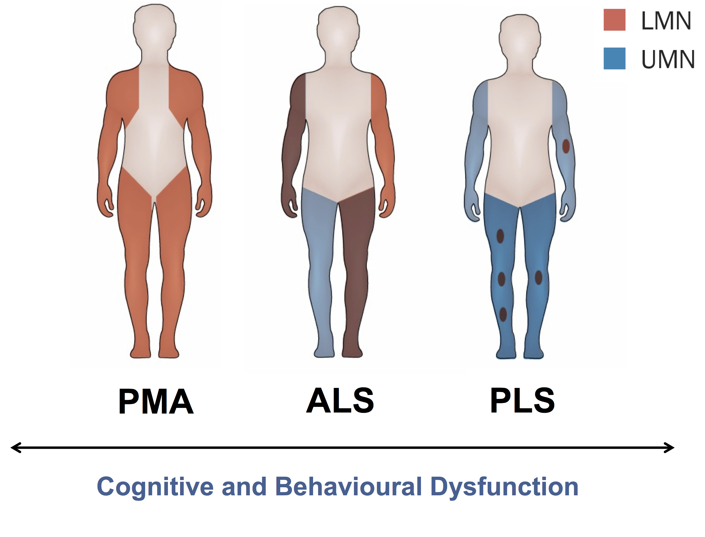 Primary lateral sclerosis and progressive muscular atrophy as a ...